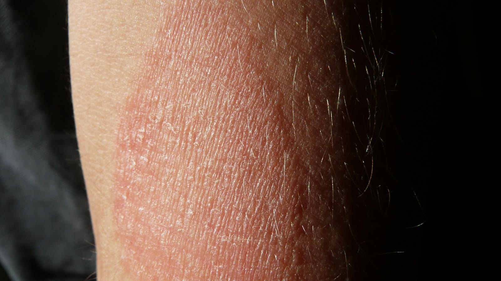 Tør, skællende og rød hud på underarm — atopisk eksem, som stress kan forværre
